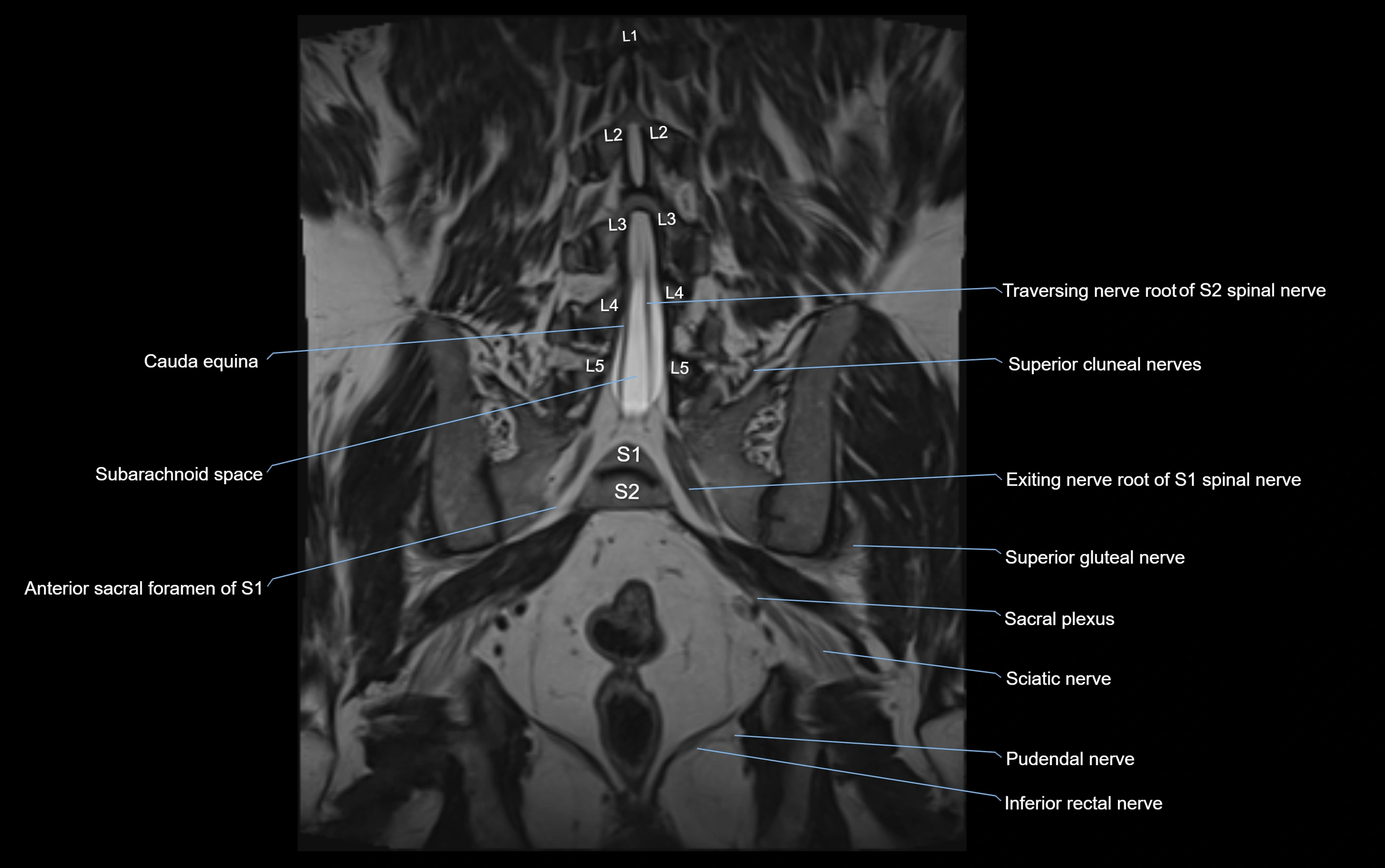MR lumbosacral plexus cross sectional anatomy 3T  radiology  image-img-09001-00049.webp